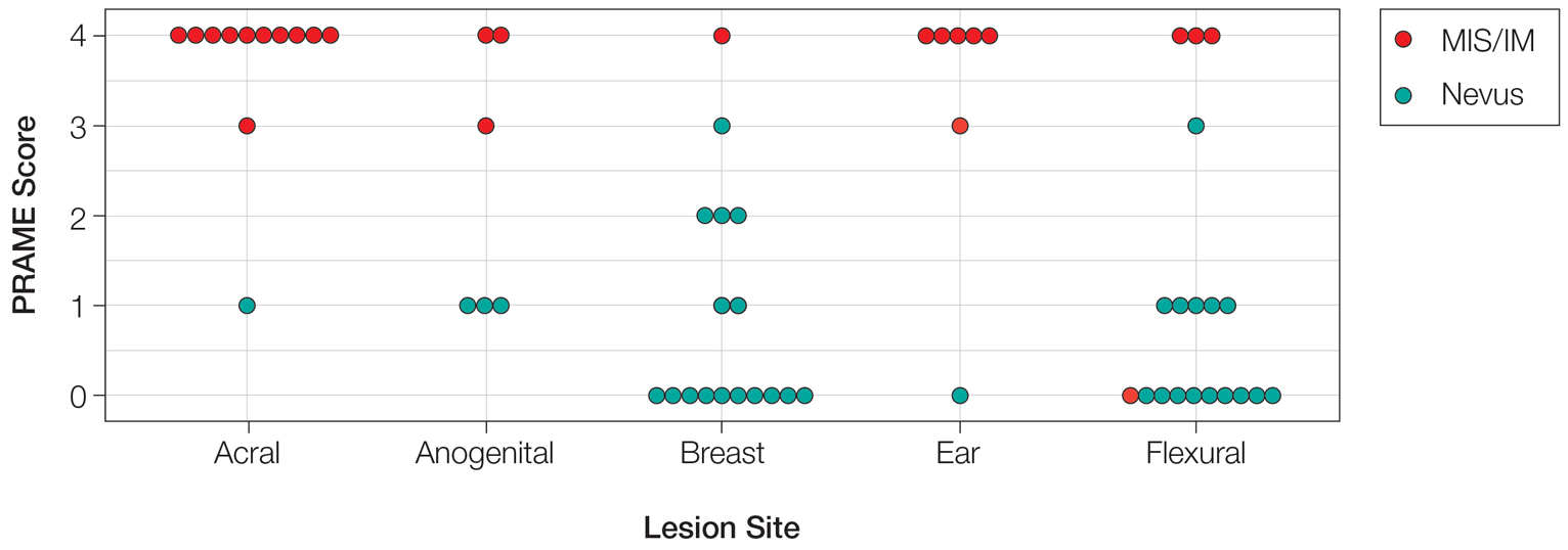 Preferentially expressed antigen of melanoma (PRAME) expression score by special-site lesion type (0=no expression; 1+=1%–25% expression; 2+=26%– 50% expression; 3+=51%–75% expression; 4+=diffuse or 76%–100% expression)