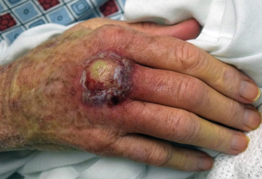 Ulcerating nodule on the dorsal aspect of the right hand with surrounding inflammation.