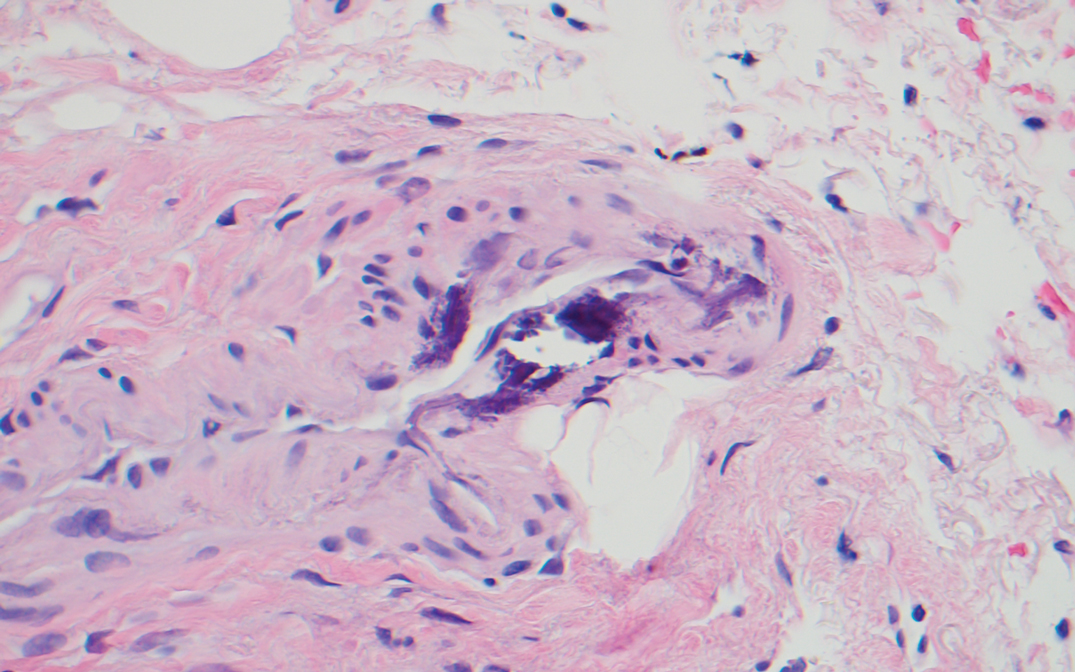 Calciphylaxis. Histopathology revealed epidermal and dermal necrosis, a perivascular neutrophilic infiltrate, and scattered microcalcifications within small- and medium-sized subcutaneous vessels (H&E, original magnification ×20). 