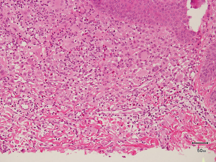 Juvenile xanthogranuloma. Mixed infiltrate with eosinophils, lipidized histiocytes, and Touton giant cells (H&E, original magnification ×200). Reference bar indicates 50 mm.