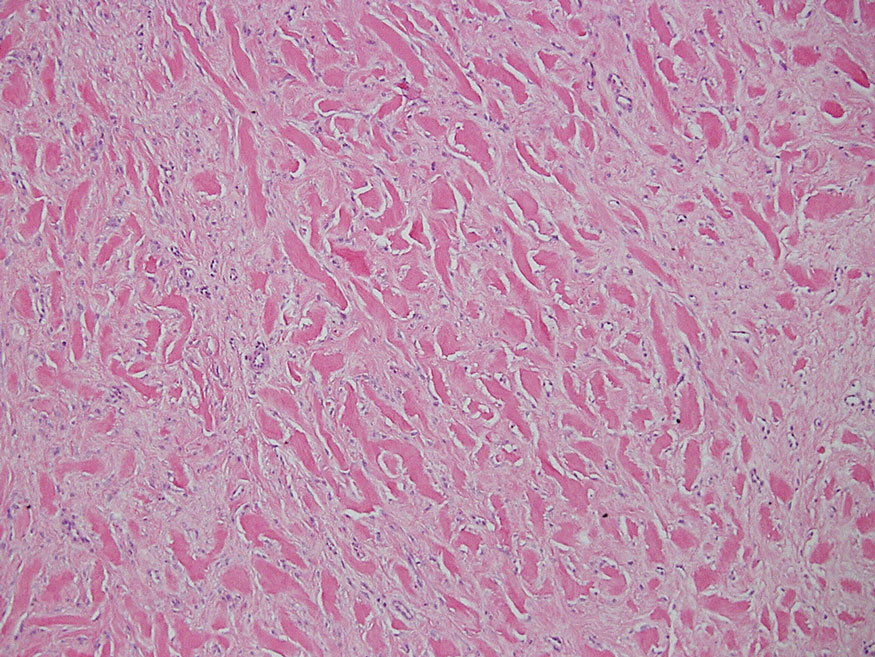 Keloid scar. Brightly eosinophilic keloidal collagen (H&E, original magnification ×400).