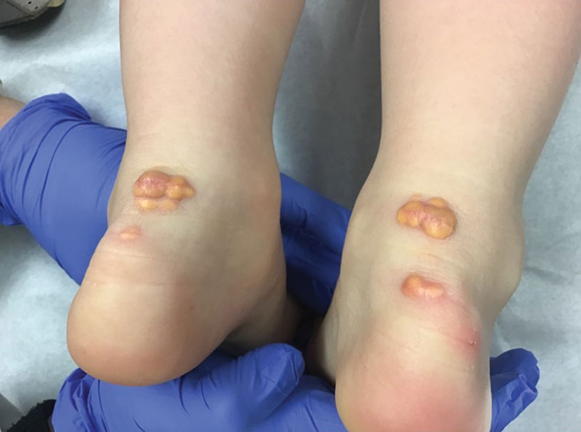 Yellow papules on the heels in a 3-year-old girl.