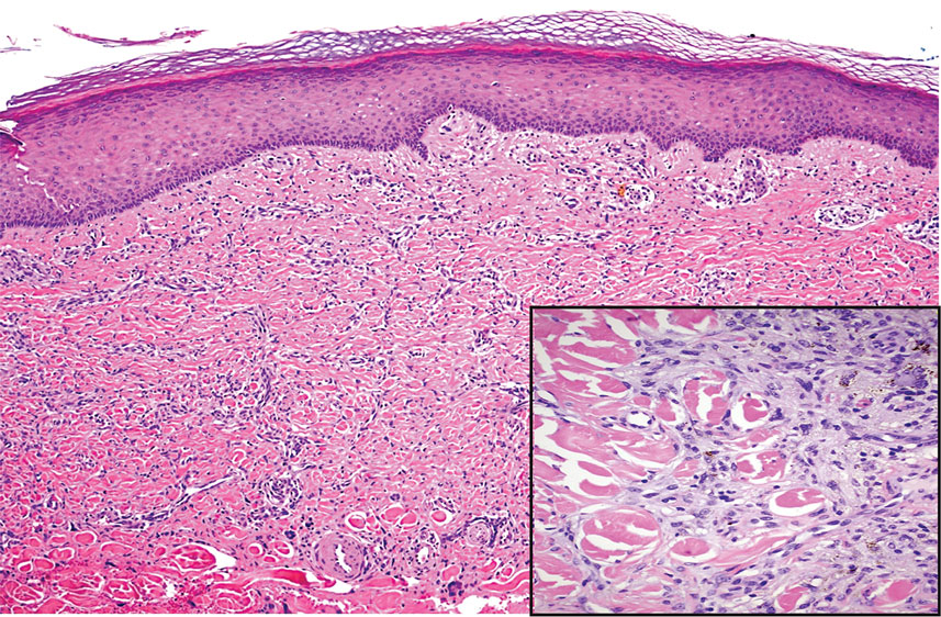 Pendulous Breasts with Reticulate, Vascular and Necrotic Plaques