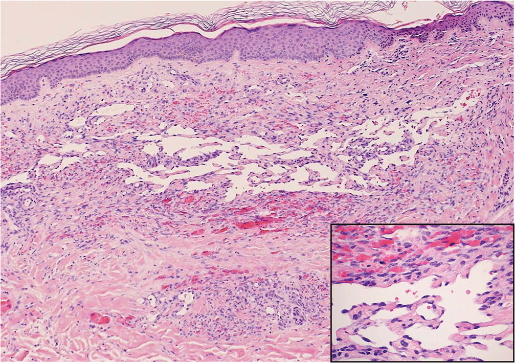 Kaposi sarcoma