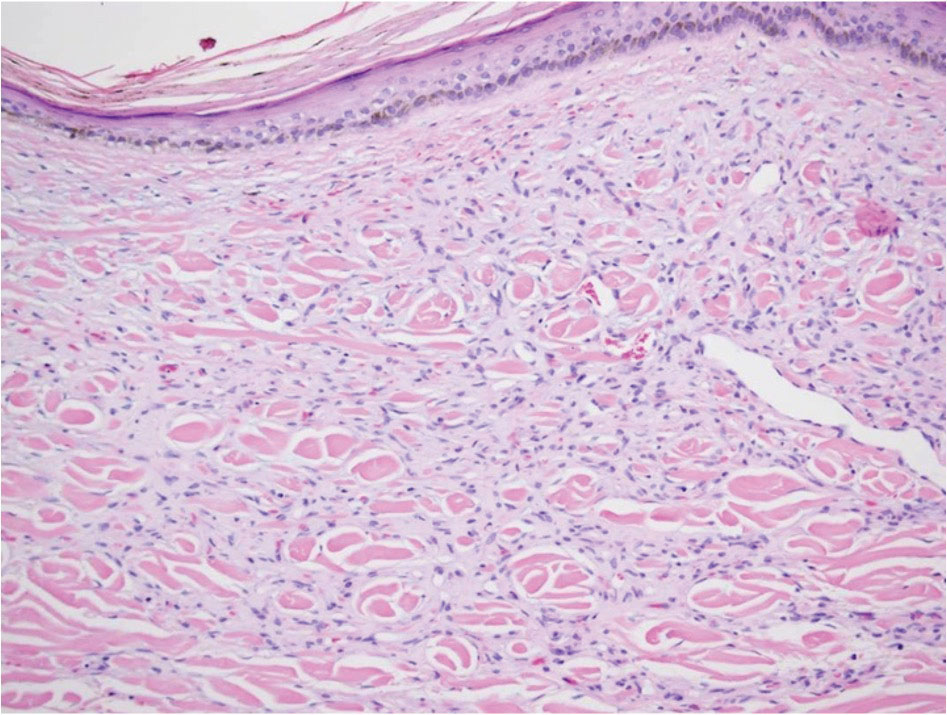 Painful, nonhealing, violaceus plaque on the right breast