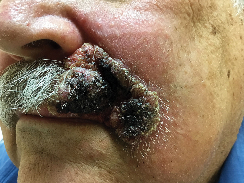 blastomycosis oral lesions