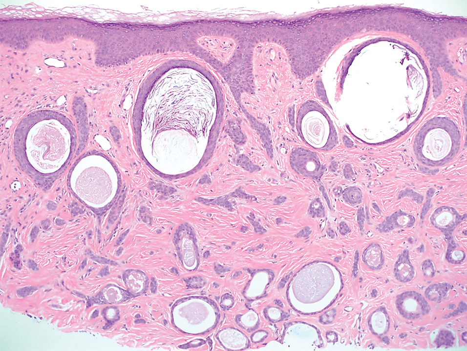 Histopathology of an initial shave biopsy permanent section of a left forehead lesion showed a transected ductal proliferation (H&E, original magnification ×100).