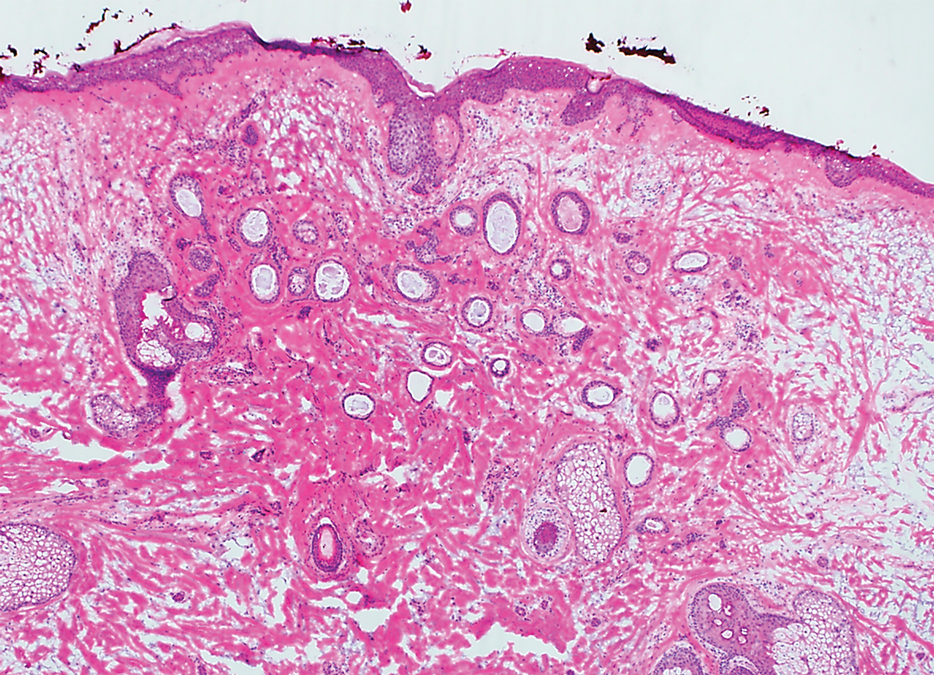 Histopathology of an intraoperative frozen section at the first stage of Mohs micrographic surgery showed peripheral margins with syringomatous change within the superficial and mid dermis (H&E, original magnification ×40).