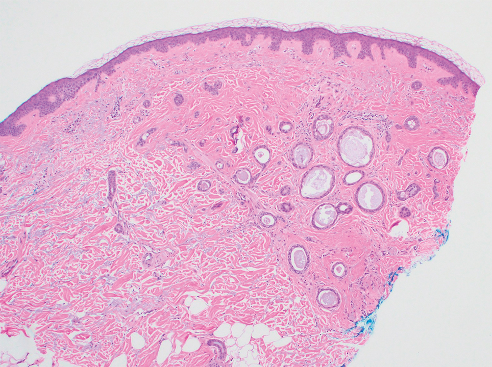 Histopathology of a postoperative permanent section from an excised Burow triangle showed only findings of plaquelike syringoma and no infiltrative component (H&E, original magnification ×40).