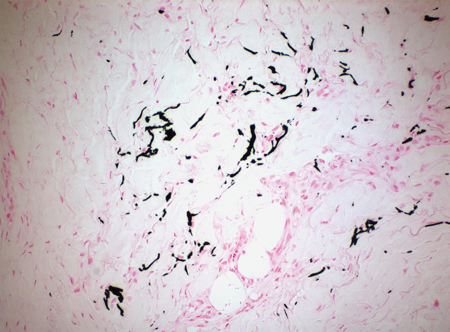 Von Kossa immunostaining showed calcifications in the subcutis that appeared black (original magnification ×200).