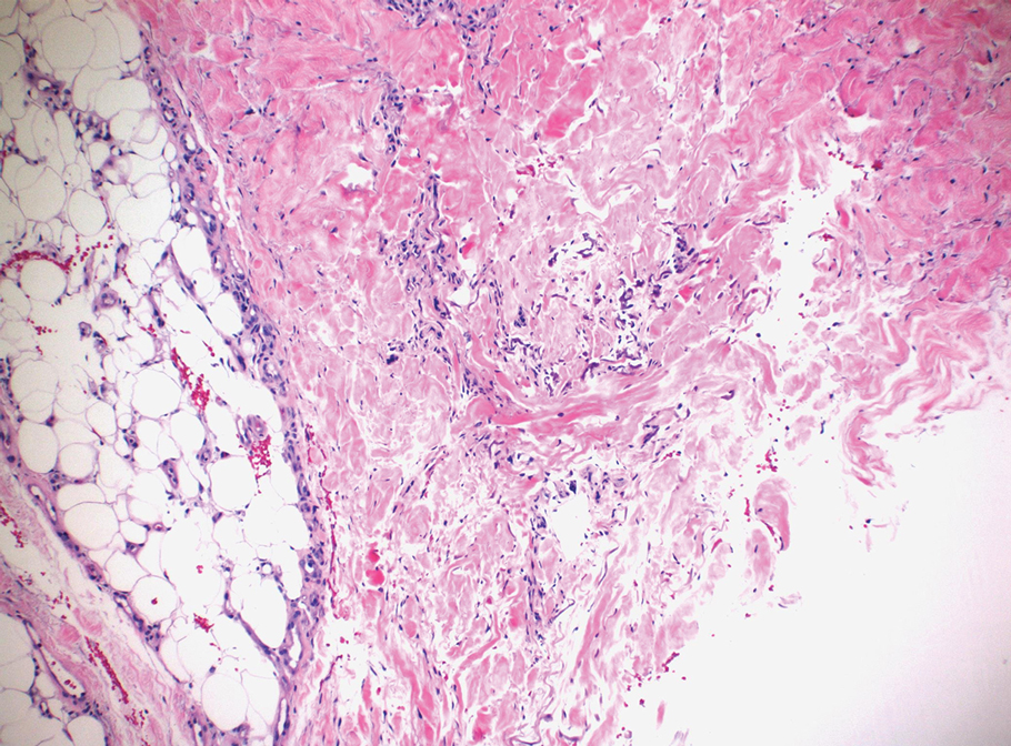 Scattered purple calcifications were interspersed in both dermal collagen and subcutaneous adipose tissue with pseudoxanthoma elasticum–like changes (H&E, original magnification ×100).