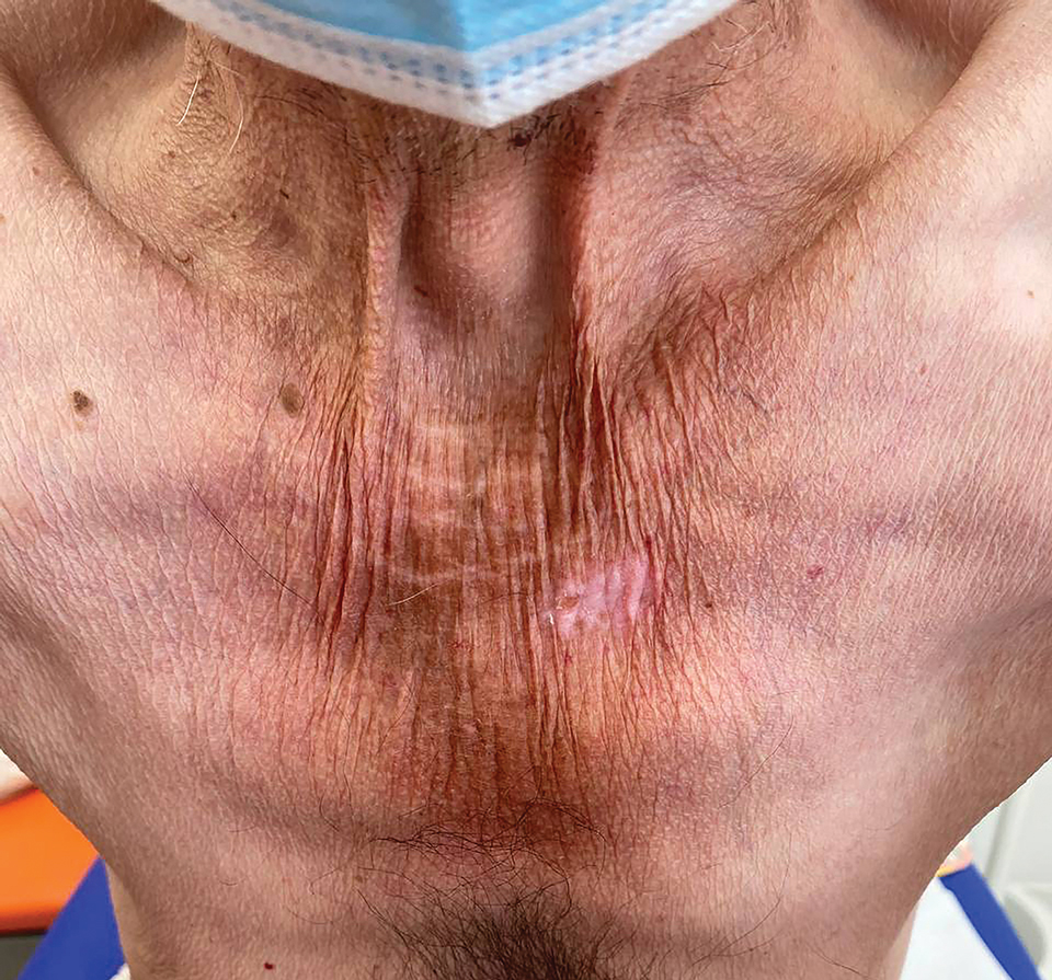 Casal necklace presenting as broad hyperpigmented scaly patches distributed along the neck in a patient with pellagra. 