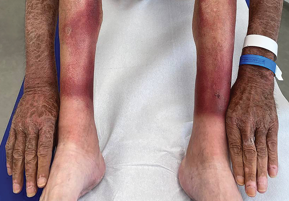 Photoexposed rash in an older adult