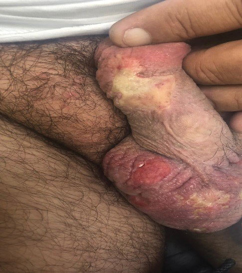 Multiple scrotal and penile ulcers that the patient self-treated with a local anesthetic cream containing lidocaine 2.5% and prilocaine 2.5%.