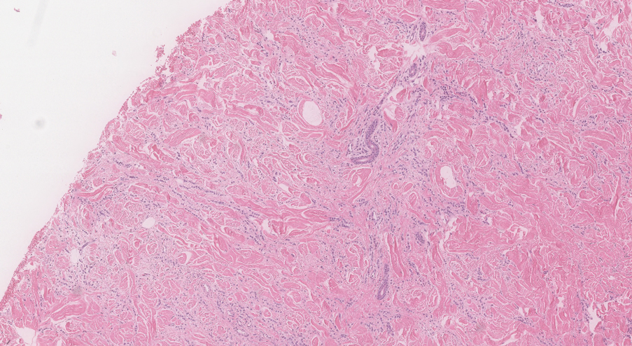  monomorphic epithelioid cell infiltrate