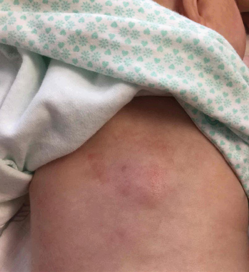 Erythematous Plaque on the Back of a Newborn