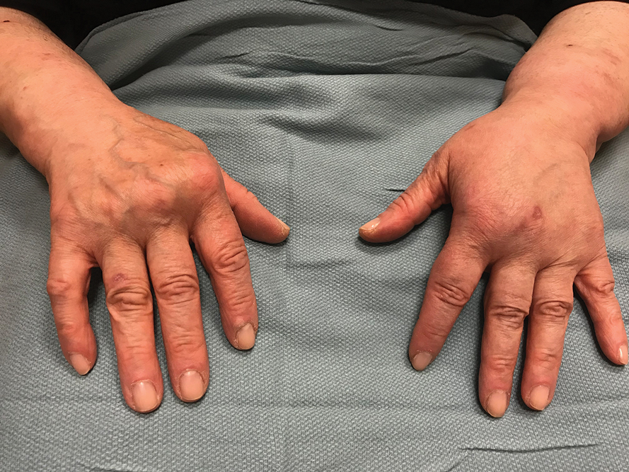 Clinical manifestation of psoriatic arthritis involving the metacarpal joints of the hands.