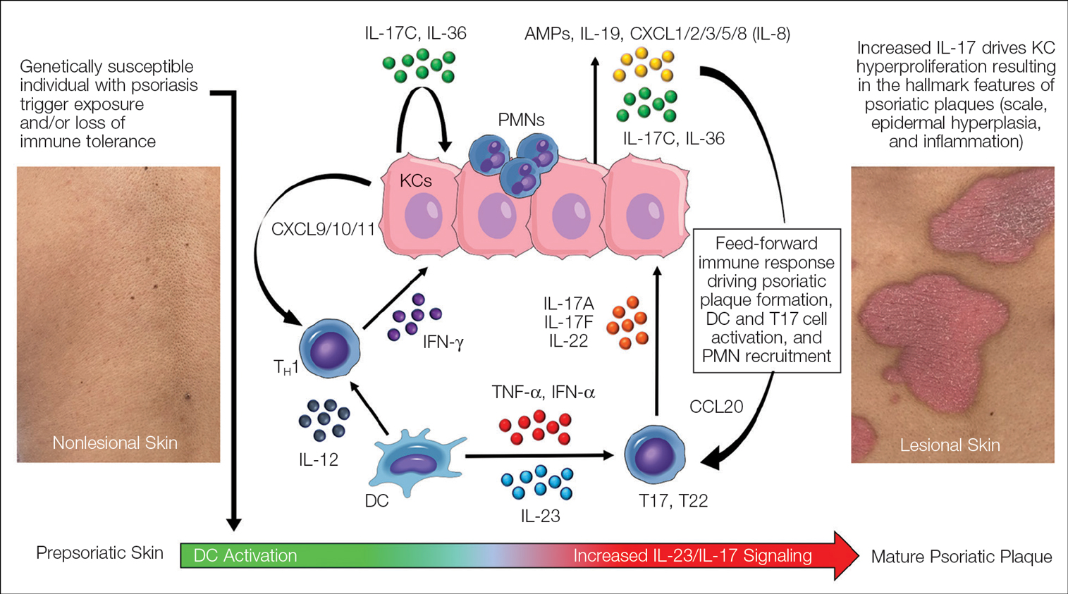 Working immune model of psoriasis.