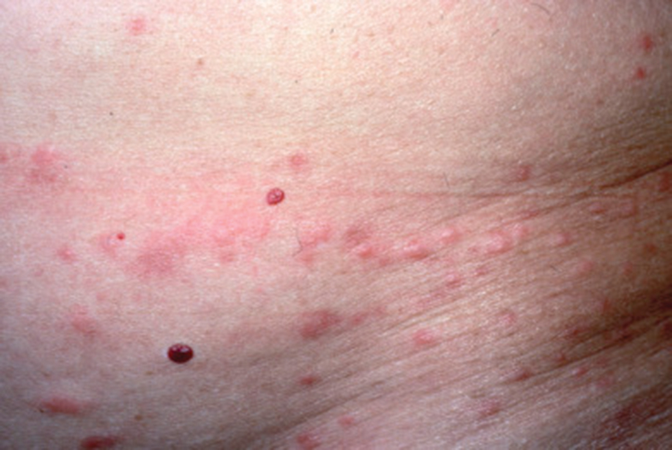 Pediculosis Corpus