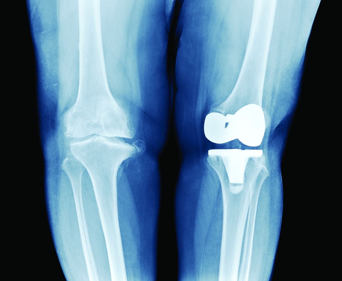 X-ray image shows total knee replacement of a person's left knee.