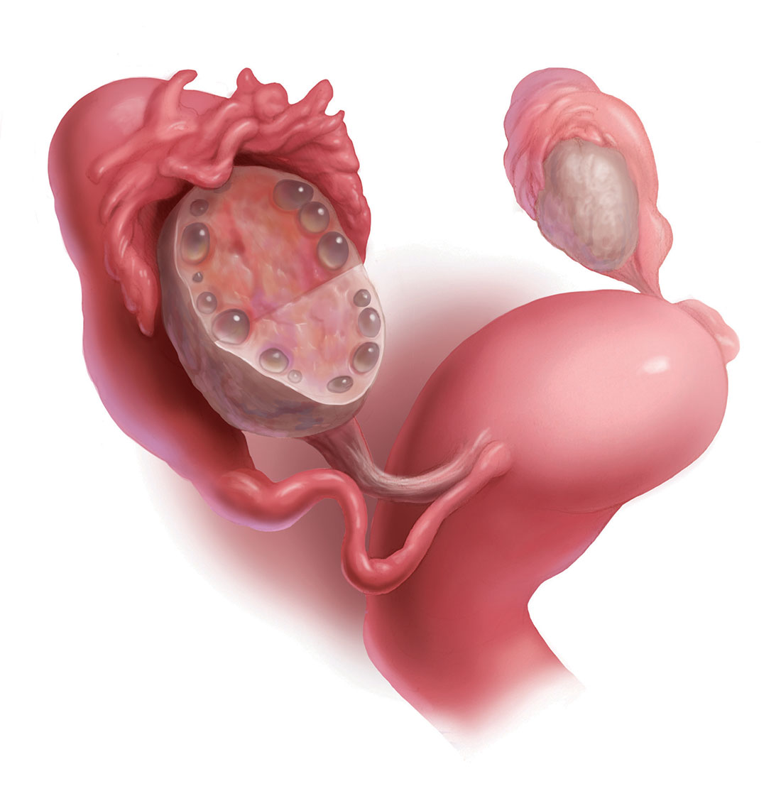 polycystic ovaries treatment pregnancy