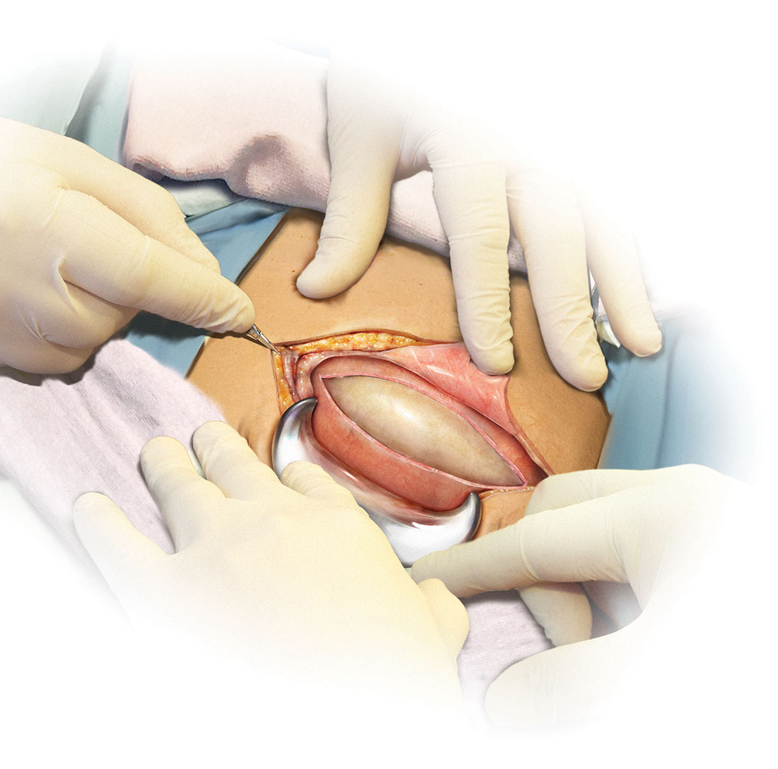 cesarean section anatomy
