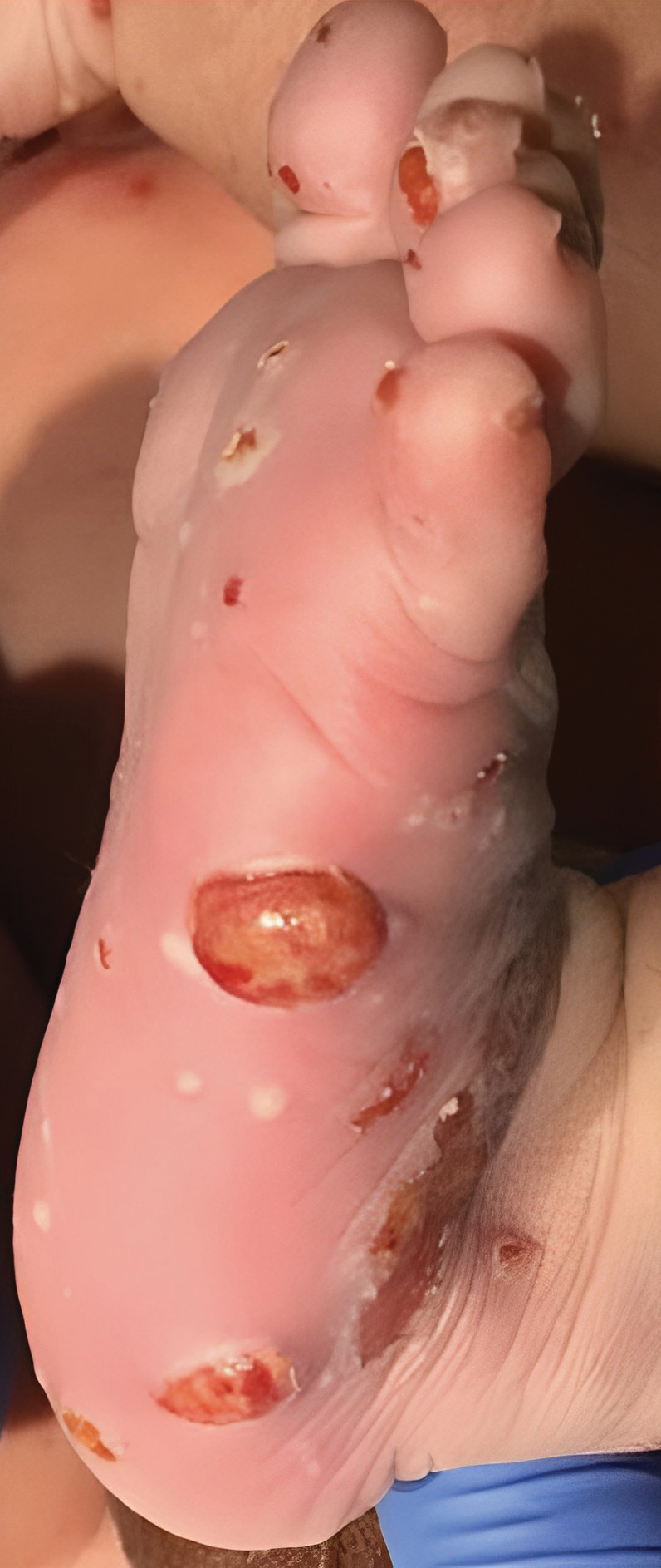 Disseminated papules and nodules on the skin and oral mucosa in an infant