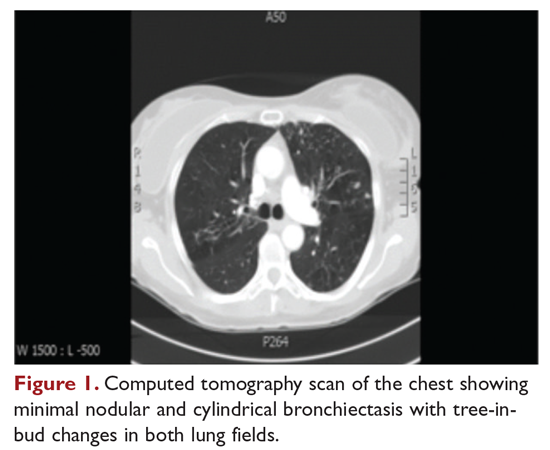 Computed tomography scan of the chest showing minimal nodular and cylindrical bronciectasis with tree-in-bud changes in both lung fields