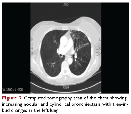 Computed tomography scan of the chest showing increasing nodular and cylindrical bronchiectasis with tree-in-bud changes in the left lung