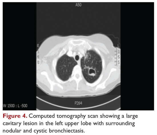 Computed tomography scan showing a large cavitary lesion in the elft upper lobe with surrounding nodular and cystic bronchiectasis