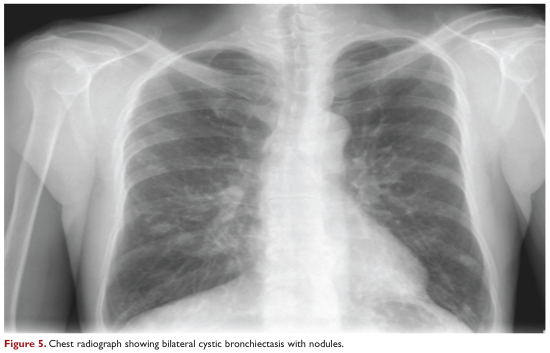 Chest radiograph showing bilateral cystic bronchiectasis with nodules