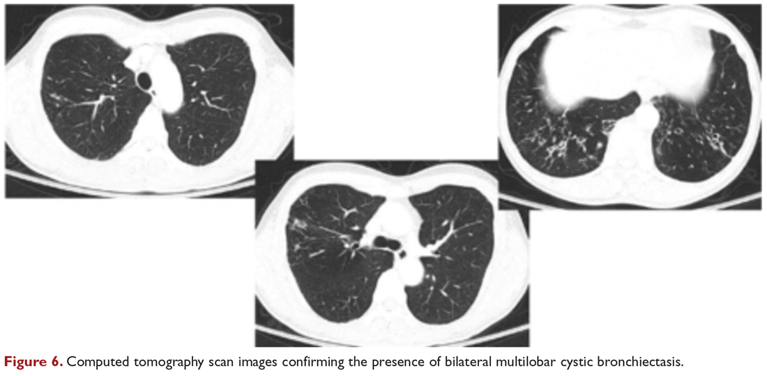 Computed tomography scan images confirming the presence of bilateral multilobar cystic bronchiectasis