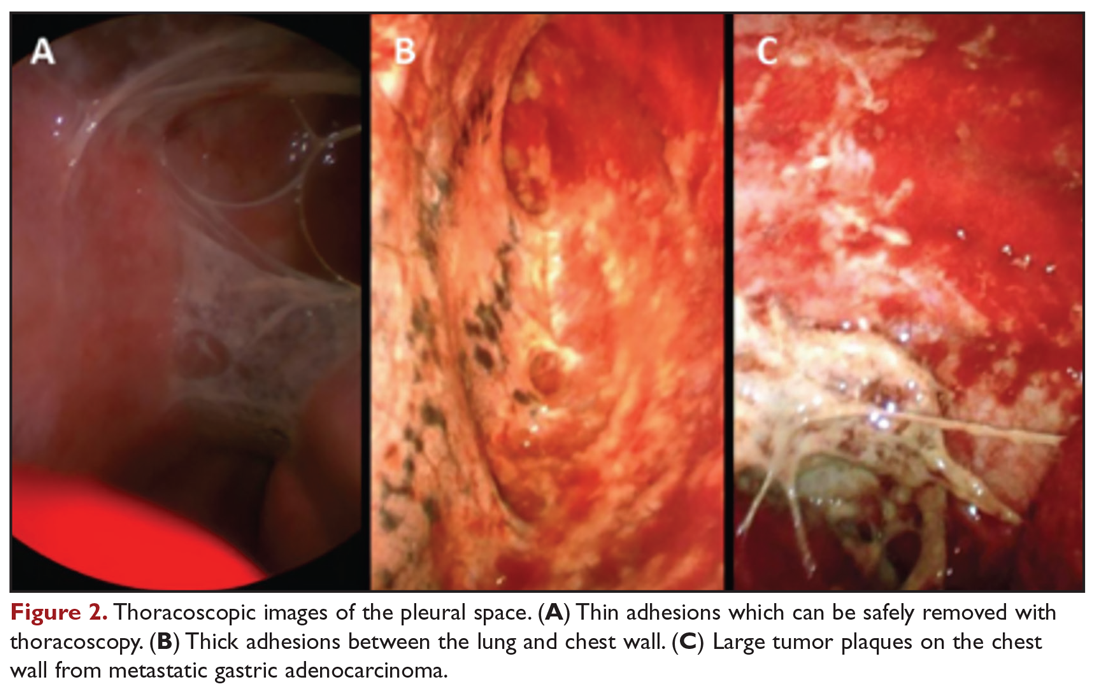 Thoracoscopic images of the pleural space. (A) Thin adhesions which can be safely removed with thoracoscopy. (B) Thick adhesions between the lung and chest wall. (C) Large tumor plaques on the chest wall from metastatic gastric adenocarcinoma.