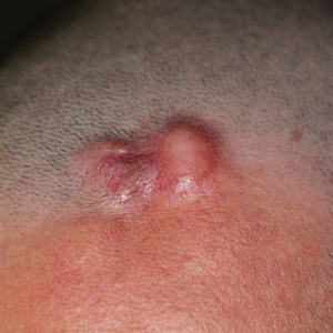 Enlarging asymptomatic nodule on the forehead