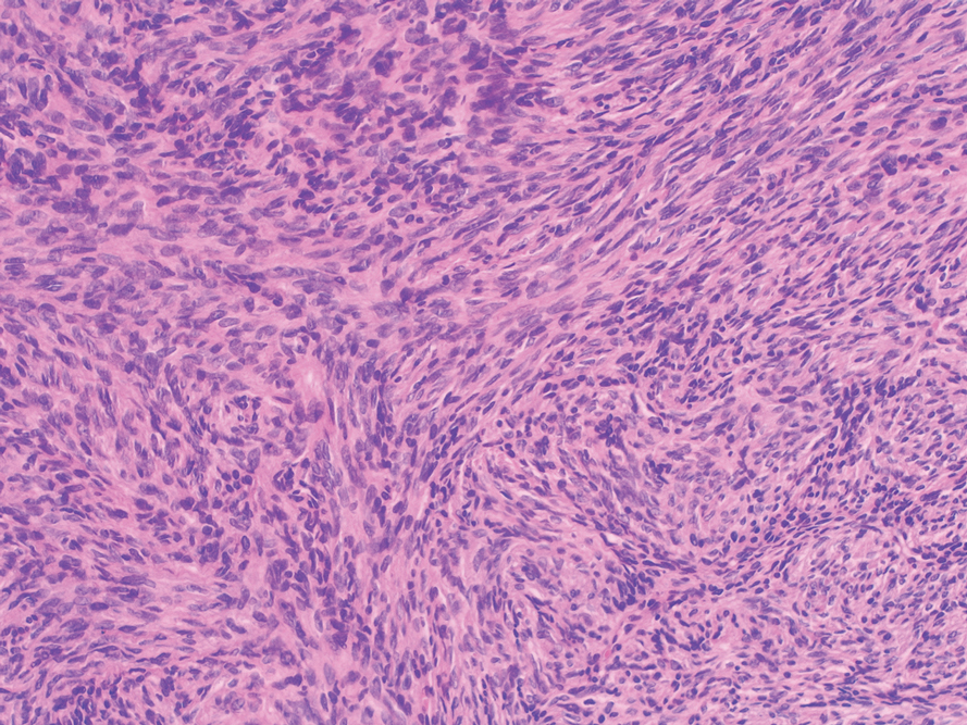 Histopathologic examination showed a dermal tumor composed of spindle cells in a storiform arrangement