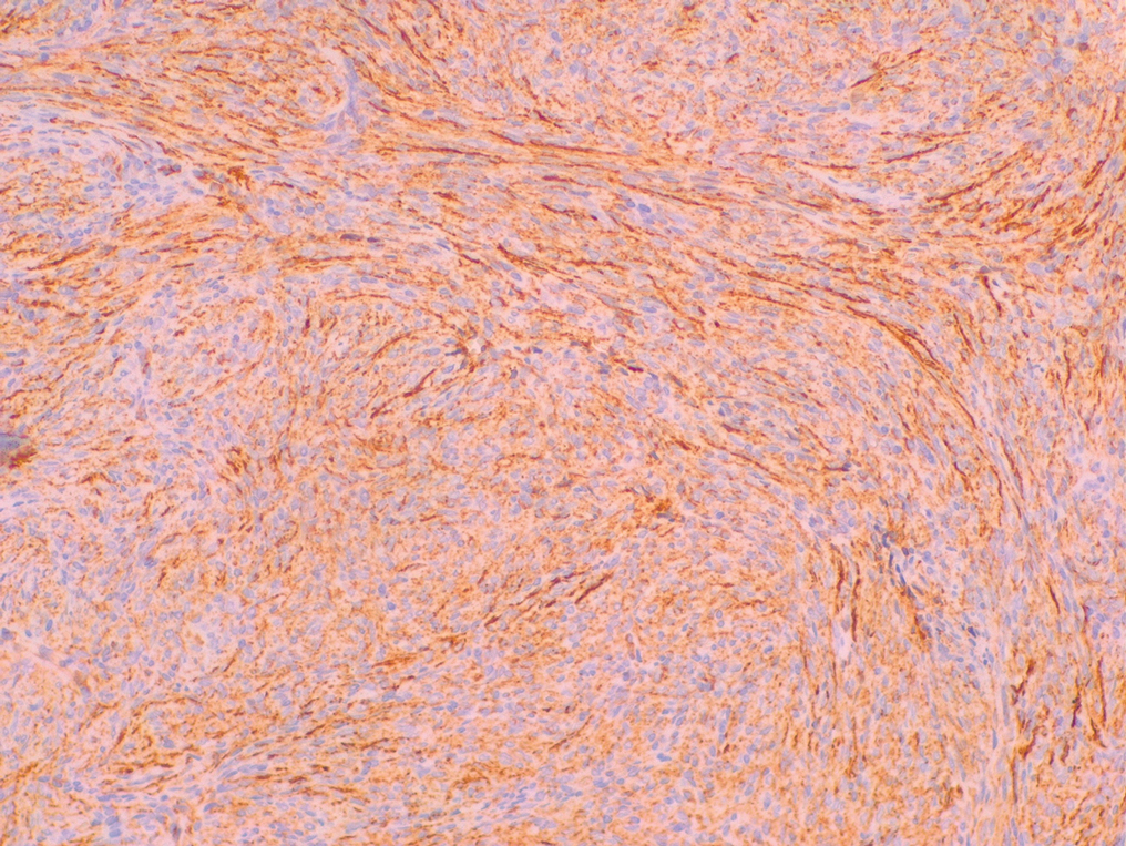 Immunohistochemistry showed positive CD34 staining of the tumoral cells