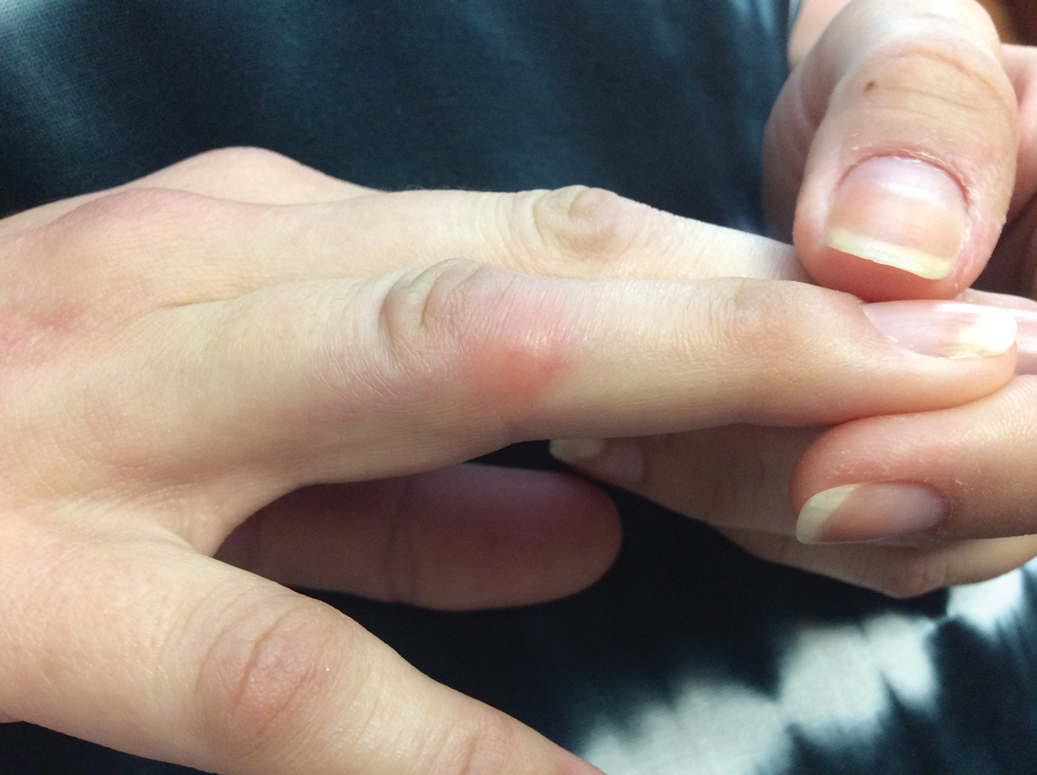 An erythematous nodule located on the proximal interphalangeal joint of the fourth finger on the right hand after ixekizumab injections for psoriasis and psoriatic arthritis.