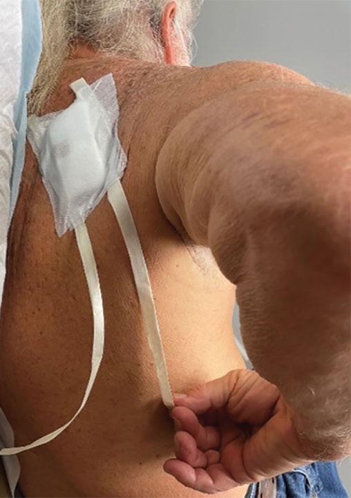 Case patient wearing prototype #1, an easy-removal pulltab bandage.