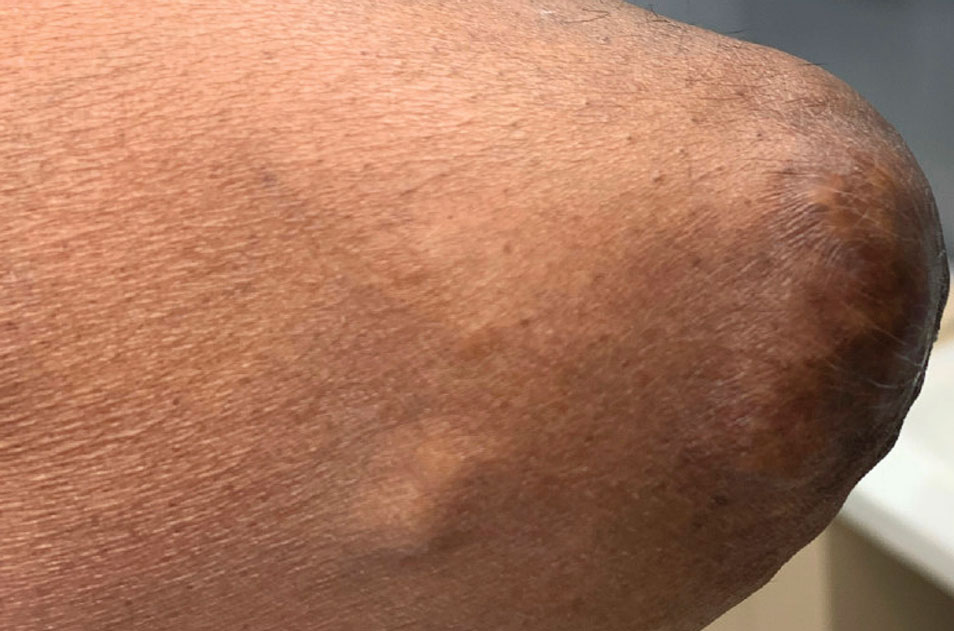 Firm nodules consistent with miliarial gout on the right elbow.