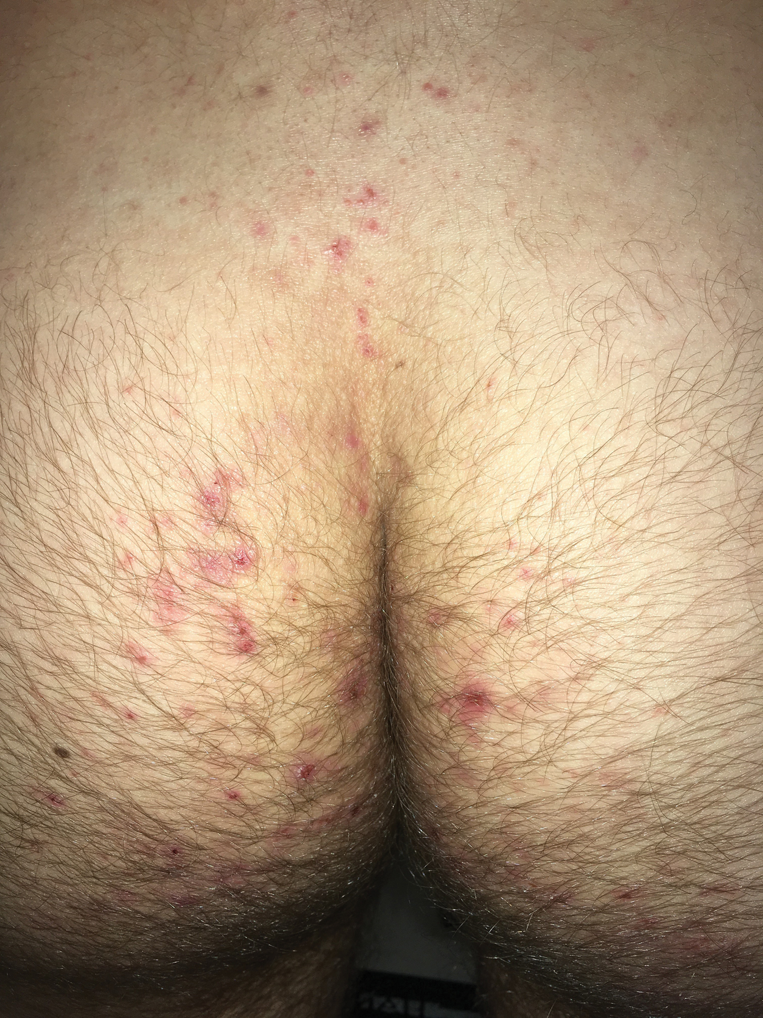 Persistent Pruritic Papules On The Buttocks Mdedge Dermatology