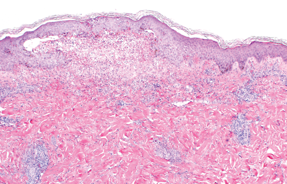 Acute epidermal spongiosis with vesicle formation and perivascular lymphohistiocytic inflammation in the superficial to mid dermis with extravasated erythrocytes