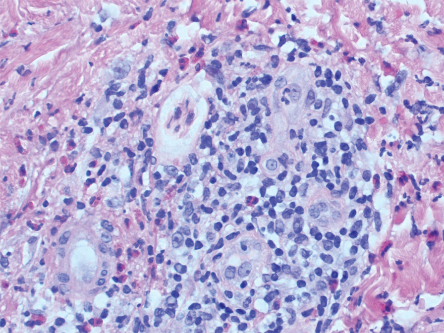 Numerous eosinophils admixed with lymphocytes surrounding a dermal blood vessel