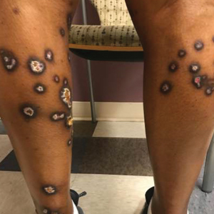 Healing erosions and bullae on the posterior aspect of the legs, with sparing on the right due to a cast, at 6-week follow-up