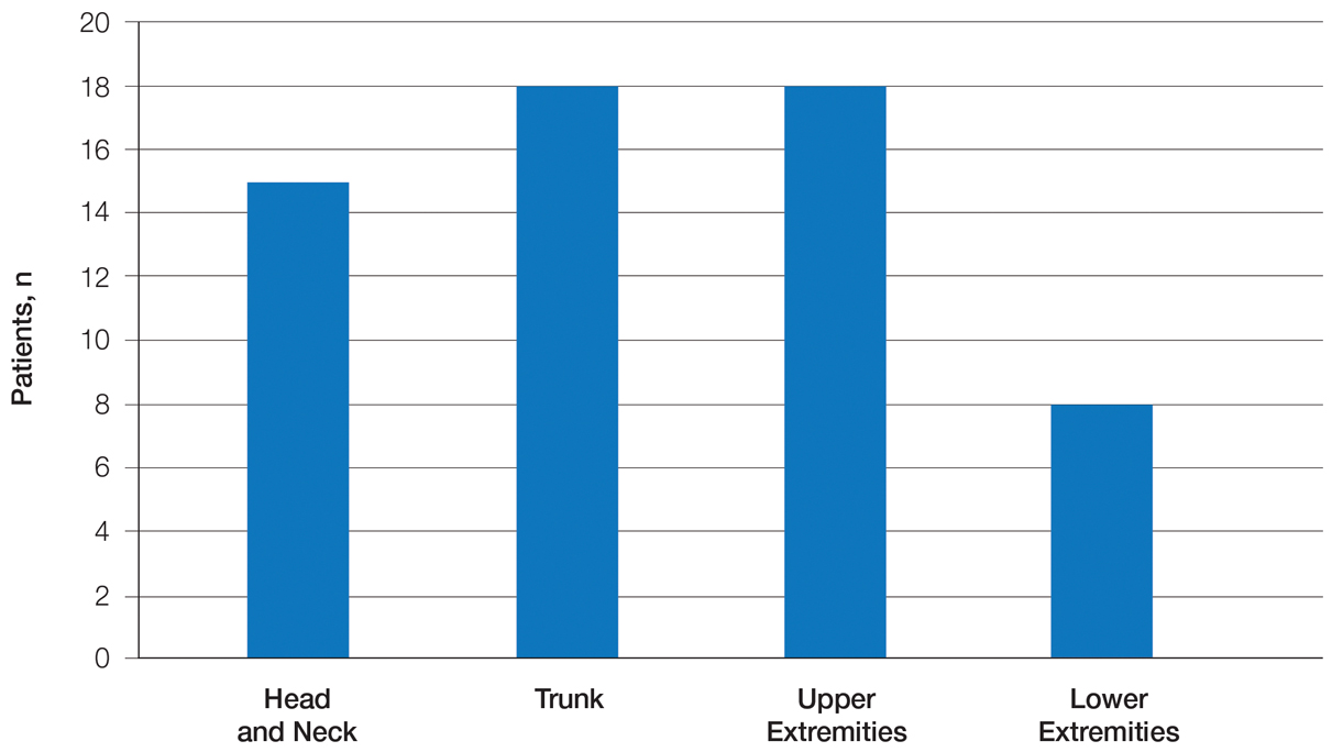 The most common anatomical distributions in patients with lupus erythematosus tumidus (N=25).