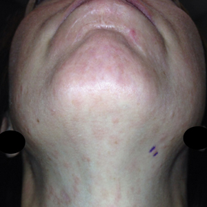 A patient with erythematous macules and papules involving the neck and face was diagnosed with lupus erythematosus tumidus