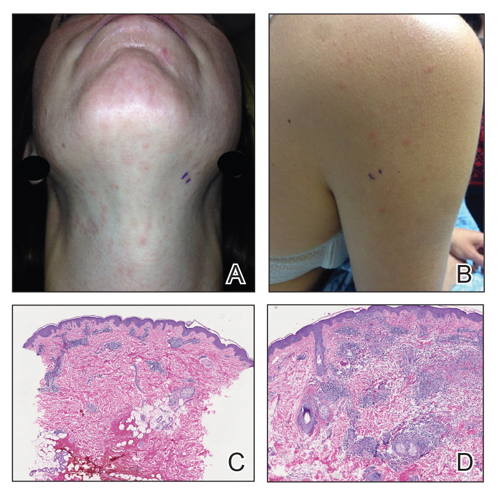 A, A patient with erythematous macules and papules involving the neck and face was diagnosed with lupus erythematosus tumidus. B, The patient also had similar morphology involving the posterior right shoulder and upper arm.