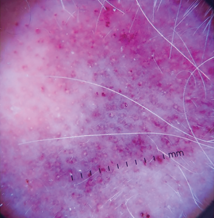 Dermoscopy of cutaneous angiosarcoma demonstrating white lines and circles in a violaceous background.