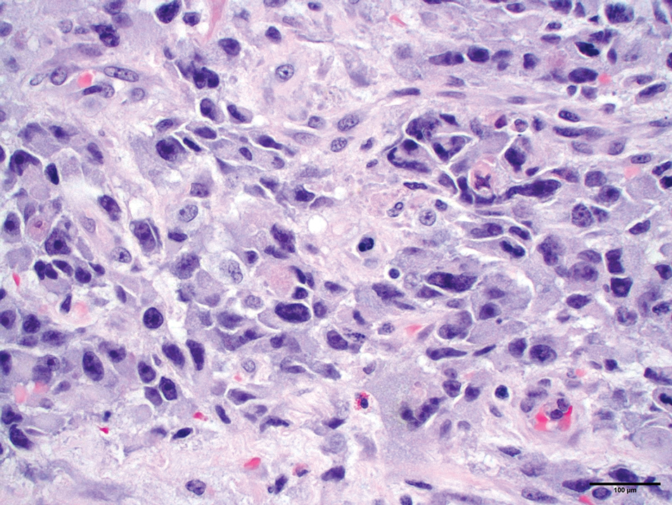 Histopathology of epithelioid angiosarcoma demonstrating irregular vascular channels with moderately atypical epithelioid cells