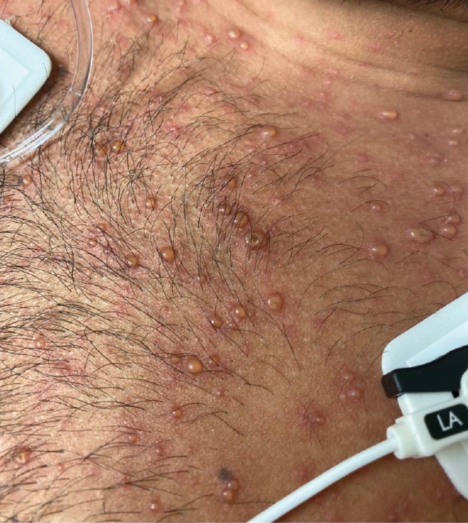 A 26-year-old man with erythematous papules and vesicopustules scattered diffusely on the chest characteristic of varicella-zoster virus.