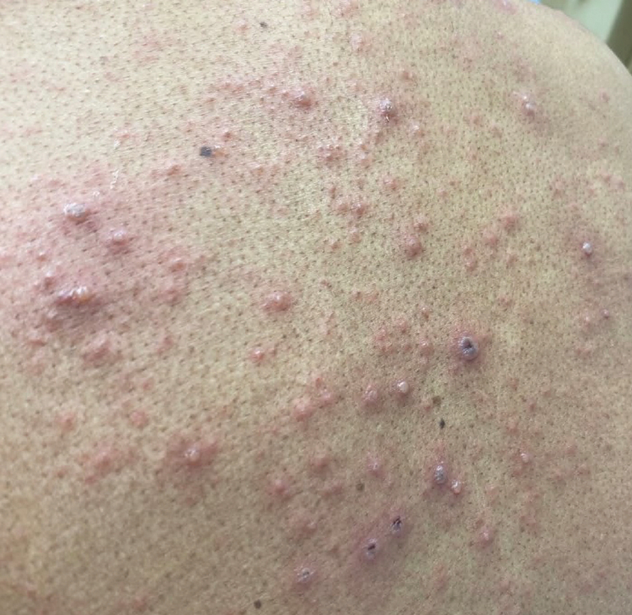 A 47-year-old man with erythematous vesicopustules in variable stages of healing widely dispersed across the upper back characteristic of varicella-zoster virus.